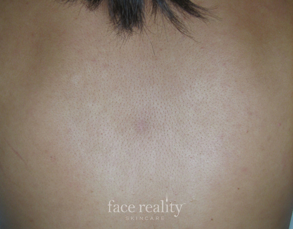 Before/After Aura Acne Clinic